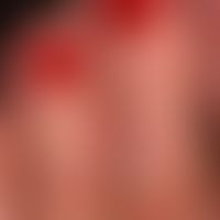 Dyshidrotische Dermatitis: chronisch rezidivierende,&nbsp; hyperkeratotische Dermatitis an Händen...