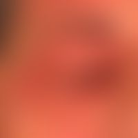 Chronische kontaktallergische Liddermatitis: therapieresistente, chronische Dermatitis, möglicher...