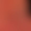 Acute contact allergic dermatitis of the eyelid: acute contact allergic dermatitis of the eyelid,...