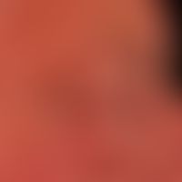 Akute kontaktallergische Liddermatitis: akute kontaktallergische Dermatitis, mit massiver beidsei...