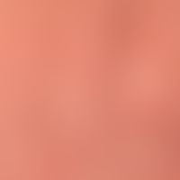 lichenification: different stages of lichenification. coarsening of the skin field. bulging of th...