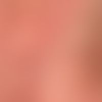 lichenification: different stages of lichenification. coarsening of the skin field. bulges of the...
