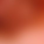 Melanom malignes superfiziell spreitendes: Auflichtmikroskpisches Bild mit unregelmäßigem Pigment...