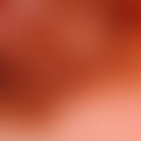 Melanom malignes superfiziell spreitendes: Auflichtmikroskpisches Bild mit unregelmäßigem Pigment...