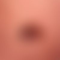 Melanom malignes superfiziell spreitendes: seit Jahren bekanntes und wachsendes Pigmentmal. Keine...