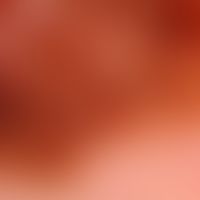 Melanom superfiziell spreitendes: auflichtmikroskpisches Bild mit unregelmäßigem Pigmentnetz (ein...