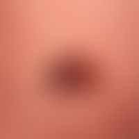 Melanoma malignes superficially spreading: pigmentation mark known and growing for years. No subj...