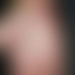 Psoriasis palmaris et plantaris: dry keratotic plaque type. Psoriasis palmaris that has not been ...