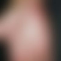 Psoriasis palmaris et plantaris: trocken-keratotischer Plaque-Typ. Nicht vorbehandelte Psoriasis ...
