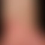 Psoriasis palmo-plantaris: Dry keratotic plaque type with sharp transition from healthy (forearm)...