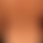 Mycosis fungoides: Plaque stage. 53-year-old man with multiple, disseminated, 1.0-5.0 cm large, i...