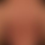 Mycosis fungoides: Plaque stage. 53-year-old man with multiple, disseminated, 1.0-5.0 cm large, i...