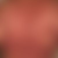 Mycosis fungoides: Tumorstadium. 53-jähriger Mann mit multiplen, disseminierten, 1,0-5,0 cm große...