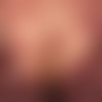Mycosis fungoides: Tumorstadium. 53-jähriger Mann mit multiplen, disseminierten, 1,0-5,0 cm große...