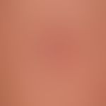 Necrobiosis lipoidica: slightly indurated plaque and atrophic surface (parchment-like skin surfac...