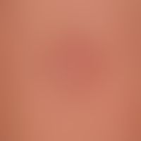 Necrobiosis lipoidica: slightly indurated plaque and atrophic surface (parchment-like skin surfac...