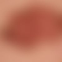 Nevus, melanocytic, dysplastic: flat, differently structured, irregularly configured, multicolour...