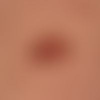 Nevus, melanocytic, dysplastic: flat, differently structured, irregularly configured, multicolore...