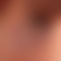 Pemphigus chronicus benignus familiaris: chronic, sharply defined, red, rough plaque with multipl...