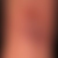 Pemphigus chronicus benignus familiaris: migrating, circulatory plaques covered with scales and c...