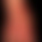 Pemphigoid&nbsp;bullöses: multiple&nbsp;pralle&nbsp;Blasen mit gelblichem und hämorrhagischem Bla...