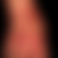 Pemphigoid&nbsp;bullöses: multiple&nbsp;pralle&nbsp;Blasen mit gelblichem und hämorrhagischem Bla...