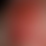 Pemphigoid scarring, type Brunsting-Perry: completely therapy-resistant, extensively reddened and...