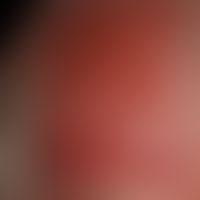 Pemphigoid scarring, type Brunsting-Perry: completely therapy-resistant, extensively reddened and...