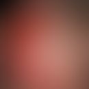 Pemphigoid scarring, type Brunsting-Perry: completely therapy-resistant, extensively reddened and...