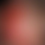 Pemphigoid scarring, type Brunsting-Perry: completely therapy-resistant, extensively reddened and...
