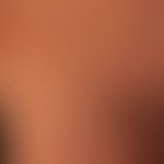Pityriasis rosea: discreet macular or plaque-shaped exanthema with tender red spots and plaques a...