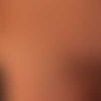 Pityriasis rosea (inverse Variante): diskretes makulöses bzw. auch plaqueförmiges Exanthem mit za...