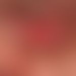 Pemphigus vulgaris: chronisch persistierende, schmerzende, flächenhafte Konjuktivitis.
