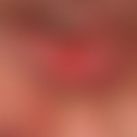 Pemphigus vulgaris: chronisch persistierende, schmerzende, flächenhafte Konjuktivitis.
