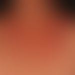 Differenziadiagnose "Tinea corporis" 

Diagnose:&nbsp;- hier vorliegend eine (seborrhoide) Psoria...