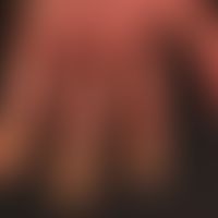 Psoriasis of the hands: here partial manifestation in the context of generalized psoriasis. No pr...