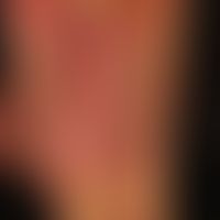 Psoriasis: hier Teilemanifestation einer generalisierten Psoriasis. Plaques,&nbsp; Papeln, Papulo...