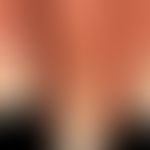 Psoriasis of the hands (Palmae, fingers): Detailed picture with periungual infestation; here, a c...