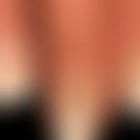 Psoriasis palmaris: Detailabbildung mit periungualem Befall. Deutliche Nageldystrophie hier mit e...