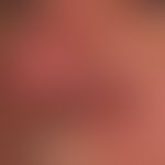 Rhinophym umschriebenes: seit 2 Jahren zunehmende, symptomlose&nbsp;lokalisierte Phymbildung am l...