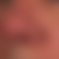 Rhinophyma: since 2 years increasing, symptomless localized phymogenesis on the left nostril; kno...