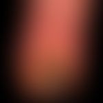 Fingerkuppennekrose: seit längerem bekanntes Raynaud-Phänomen. Jetzt akut auftretende hämorrhagis...