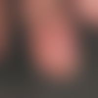 Fingertip necrosis of Digitus III in a 52-year-old female patient with progressive systemic scler...