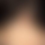 Sclérodermie en coup de sabre: seit Jahren zunehmende symptomlose Furchenbildung in Stirnmitte.
