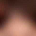 Sclérodermie en coup de sabre: seit Jahren zunehmende symptomlose Furchenbildung in Stirnmitte. S...