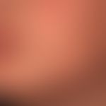 Tinea faciei: Zustand nach antimykotischer Systemtherapie.

