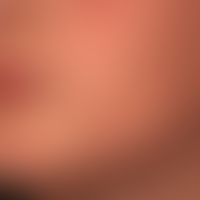 Tinea faciei: Zustand nach antimykotischer Systemtherapie.
