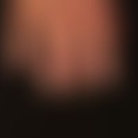 Thrombangiitis obliterans: decades of nicotine abuse. 12 months of acrozynosis (even more severe ...