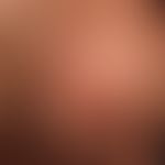 Tinea capitis superficialis: easily inflammable, blurred, alopecic focus in the occipital region ...
