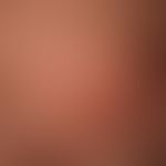 Tinea capitis superficialis: easily inflammable, blurred, alopecic focus in the occipital region ...